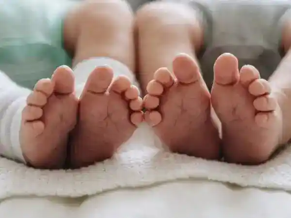 Pemulihan Bayi Kembar Siam Setelah Operasi Pemisahan di RSCM